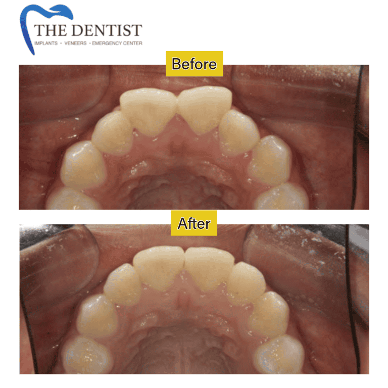 Before and after braces treatment at The Dentist Birmingham