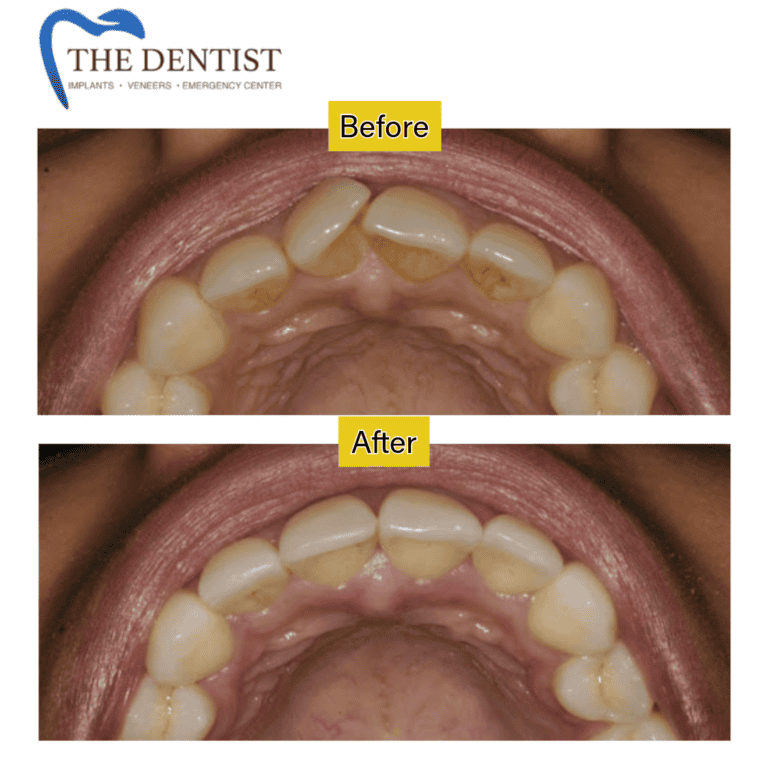 Before and after braces treatment at The Dentist Birmingham