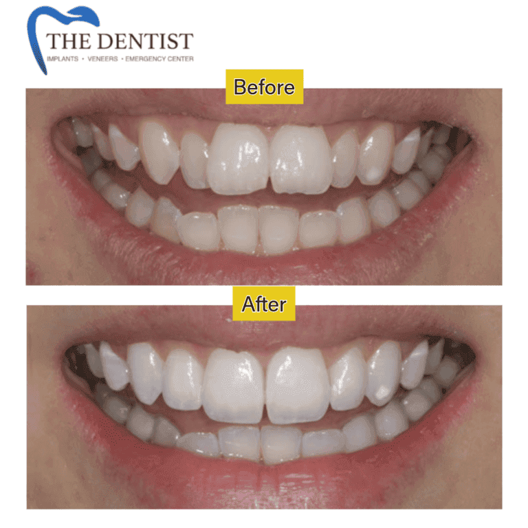 Before and after braces treatment at The Dentist Birmingham