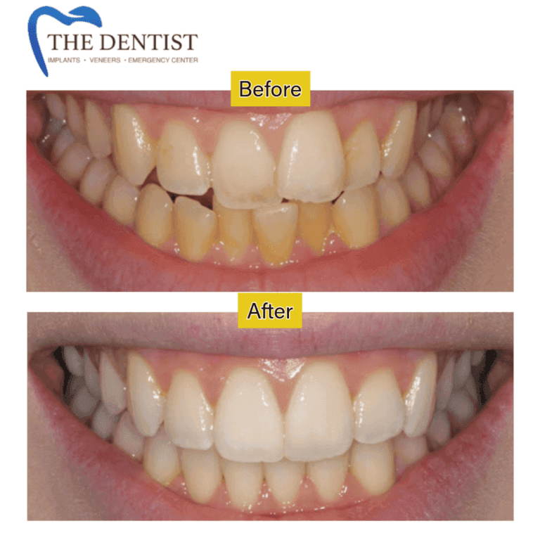 Before and after braces treatment at The Dentist Birmingham