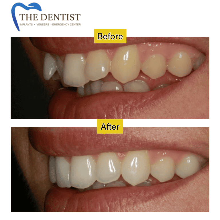 Before and after braces treatment at The Dentist Birmingham