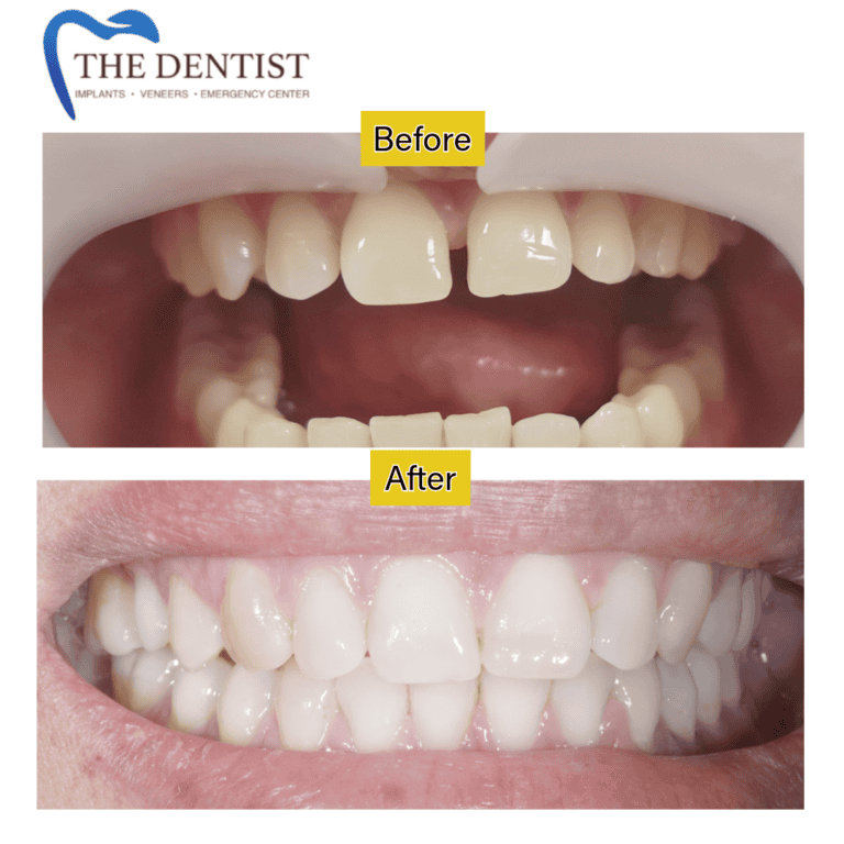 Before and after braces treatment at The Dentist Birmingham