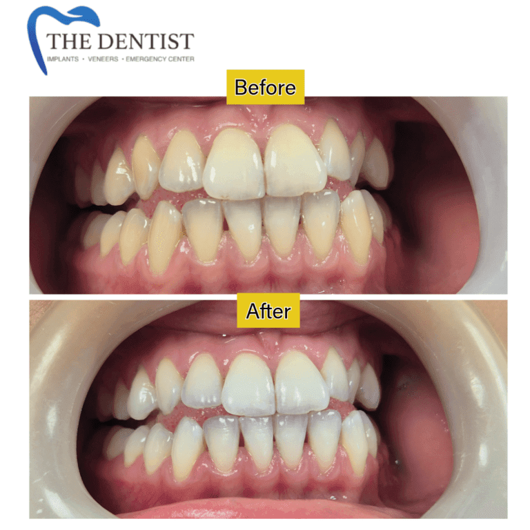 Before and after professional teeth whitening at The Dentist Birmingham