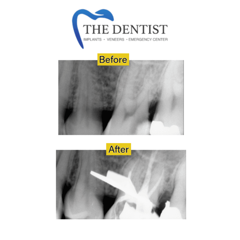Before and after root canal treatment at The Dentist Birmingham