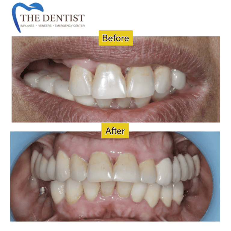 Before and after dental implant at The Dentist Birmingham