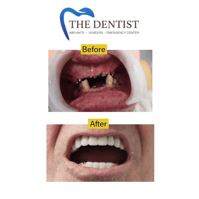 Before and after dental implant at The Dentist Birmingham