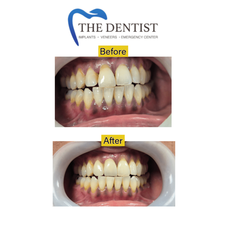 Before and after root canal treatment at The Dentist Birmingham