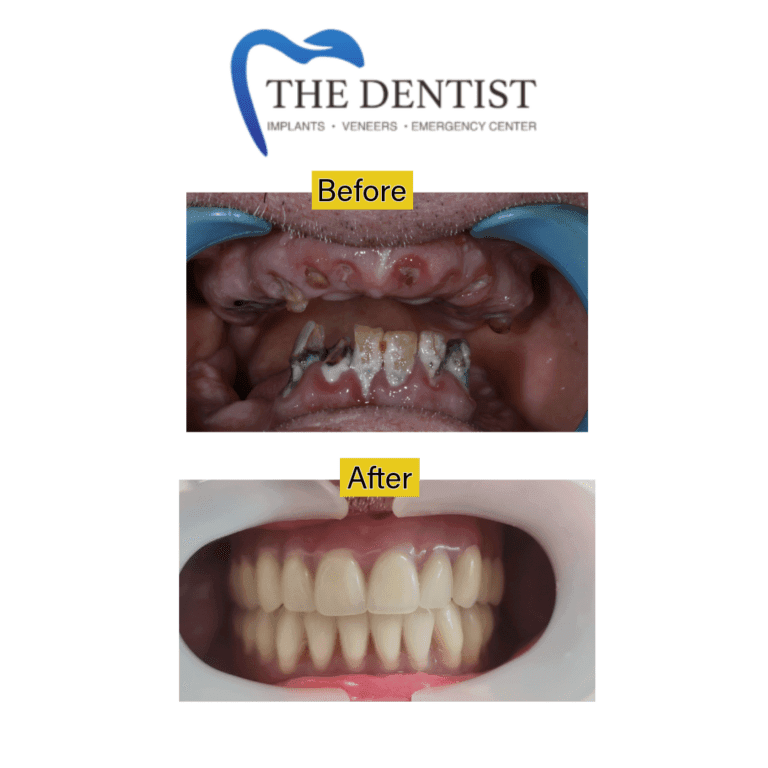 Before and after dental implant at The Dentist Birmingham