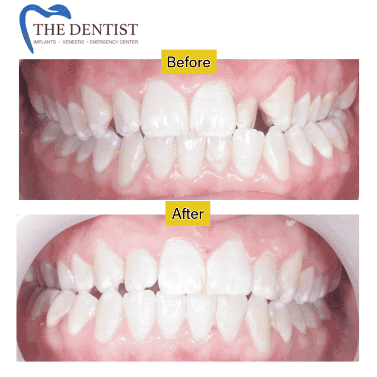 Before and after braces treatment at The Dentist Birmingham