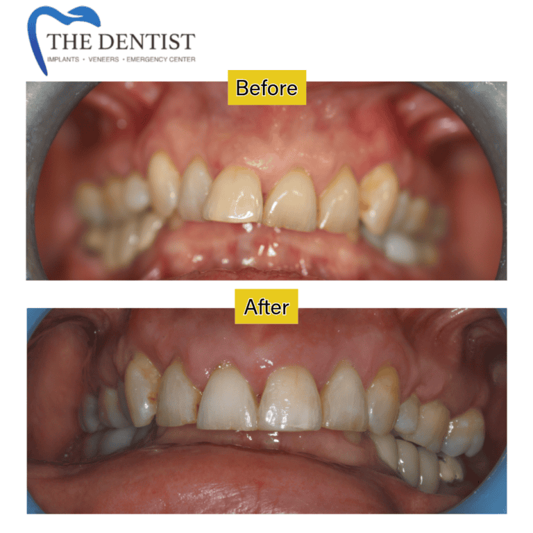 Before and after braces treatment at The Dentist Birmingham