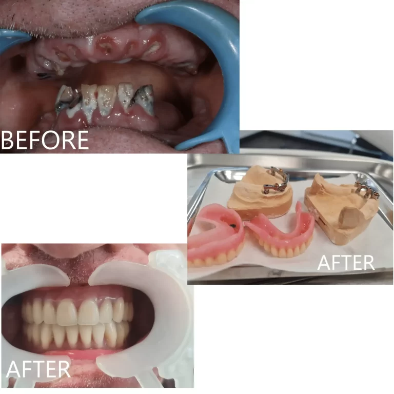 Before and after full arch dental implants at The Dentist Birmingham