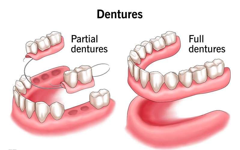 denture