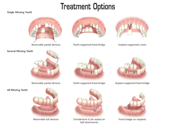 missing teeth, tooth replacement options at the dentist west midlands