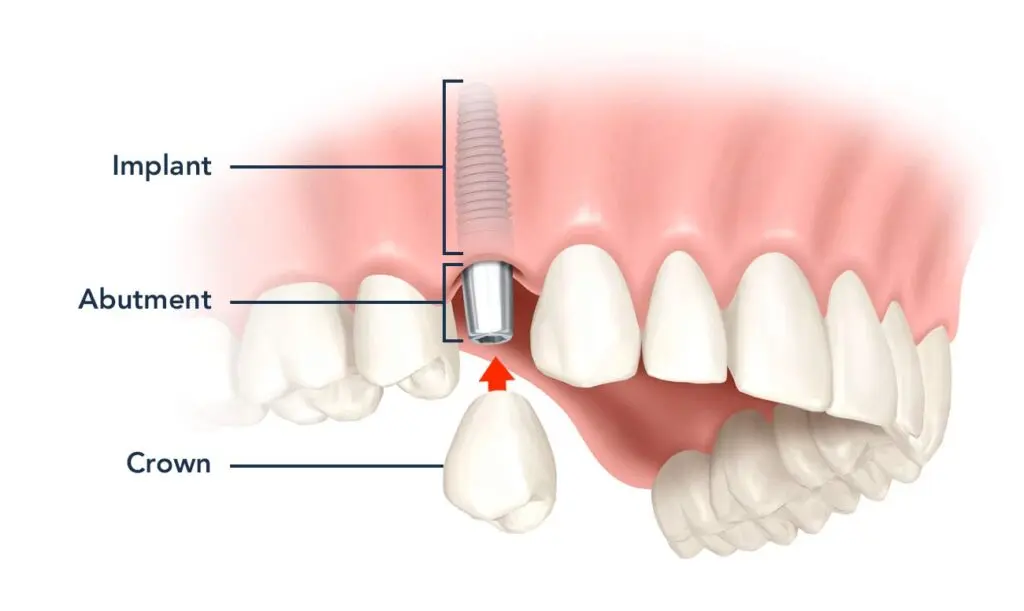 Dental implants diagram