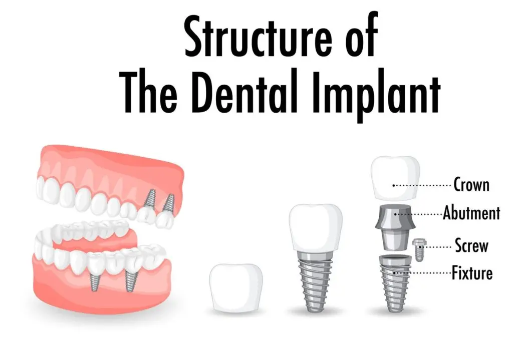 Structure of a dental implant