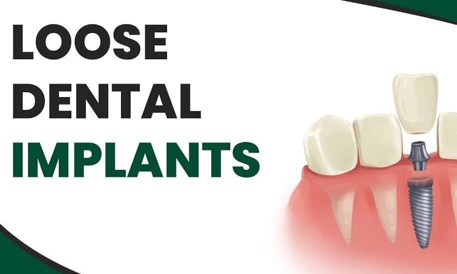 image of animated dental implant written loose dental implants by The Dentist West Midlands (crowns, Caps)