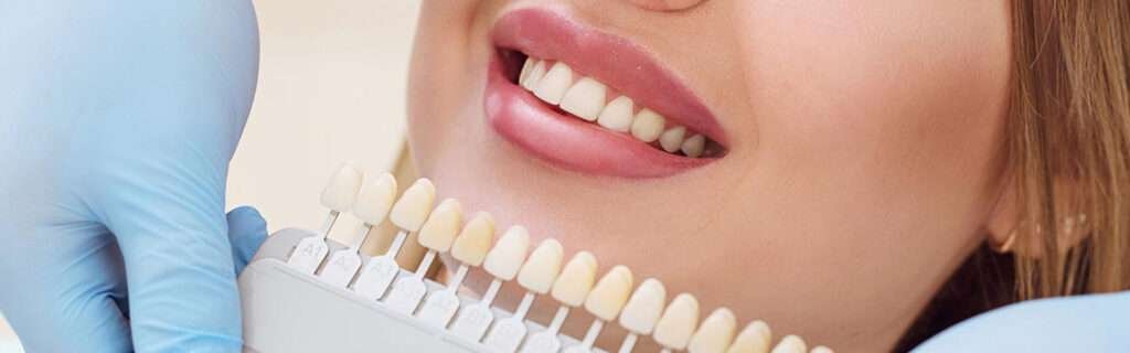 dental veneer treatment using relyx not with superglue