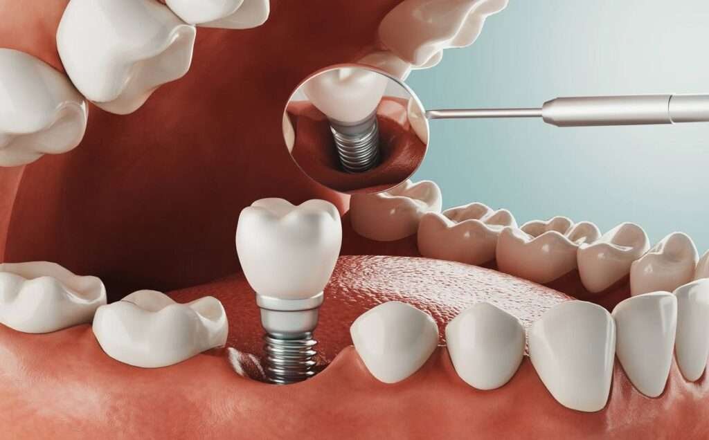 What is Single Tooth Implant in Birmingham