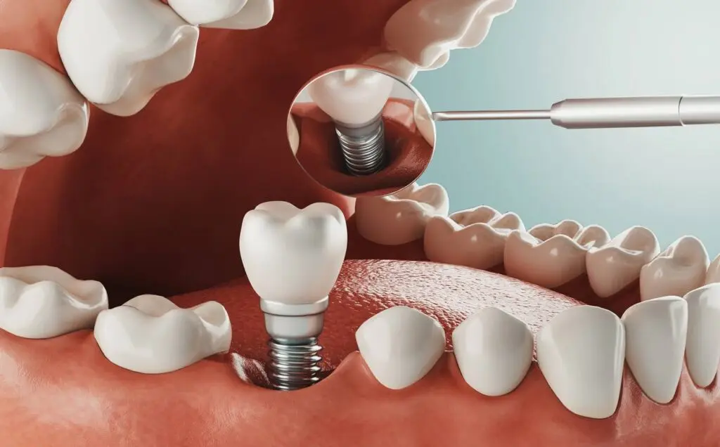 Single tooth implant illustration