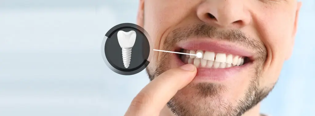 Single tooth implant appearance