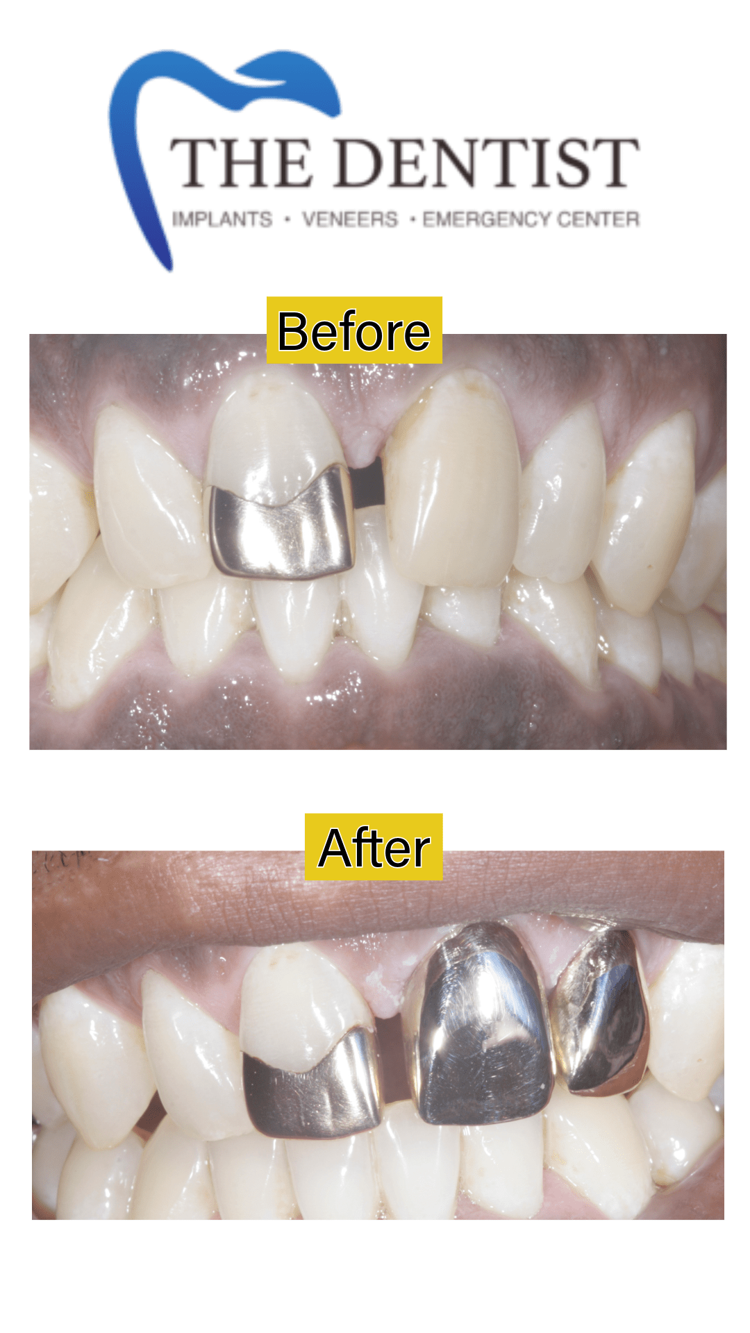 Extensive gold crown on a dental implant