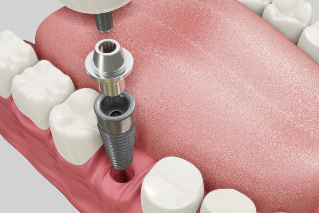 Dental implant treatment procedure illustration