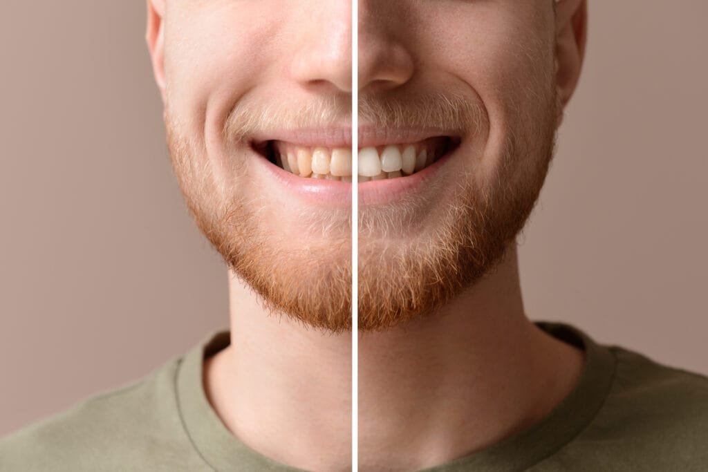 Before and after comparison of a man's teeth whitening results