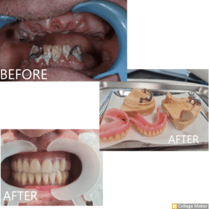 Before and after image of dental treatment showcasing dental work and the final result