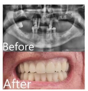Full Mouth Dental Implants | Before & After Results at The Dentist West Midlands.