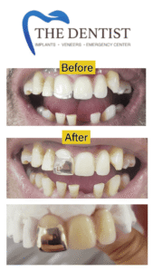 Gold Crown Restoration | Before & After | The Dentist West Midlands.
