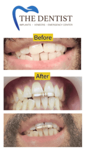 Cosmetic Dentistry | Before & After | The Dentist West Midlands