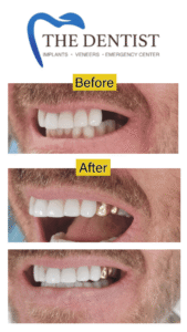 Gold Tooth Restoration | Before & After | The Dentist West Midlands