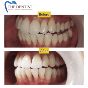 Smile Makeover – Expert Teeth Alignment & Whitening for a Brighter, Healthier Smile at The Dentist West Midlands.