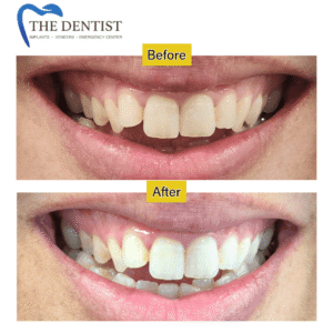 Transform Your Smile with Expert Cosmetic Dentistry – Teeth Whitening, Veneers & Orthodontics at The Dentist West Midlands