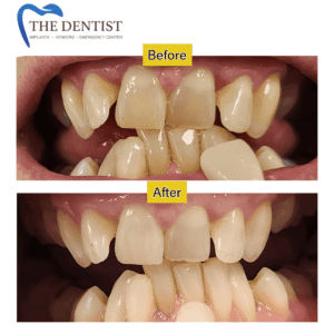 Teeth Straightening & Alignment Correction – Achieve a Healthier, More Confident Smile at The Dentist West Midlands