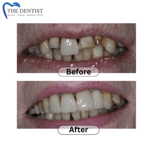 Before-and-after transformation featuring improved smile with crowns and veneers.