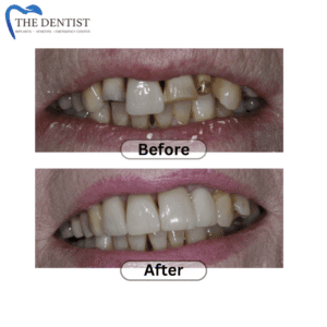Before-and-after photos showing a significant improvement in tooth color following a teeth whitening procedure