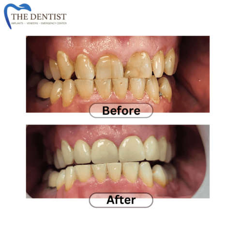 Before-and-after transformation showcasing a renewed smile using dental crowns and veneers.