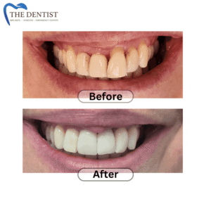 Before-and-after dental implant results, showcasing a restored smile and improved tooth function.
