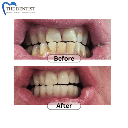 Before-and-after composite bonding results, highlighting improved tooth shape and color for a more confident smile.