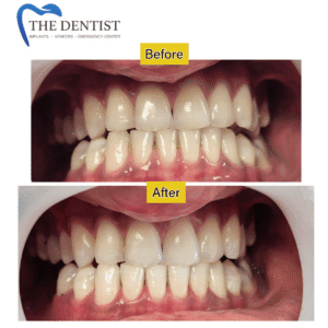 teeth whitening before and after the dentist, birmingham, west midlands, UK