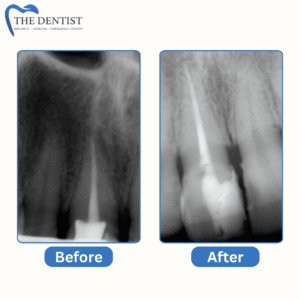 Before-and-after X-ray images showing successful root canal treatment and improved tooth health