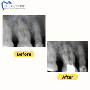 Before-and-after X-rays of a root canal procedure, showing successful treatment and improved tooth health