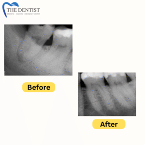 Before-and-after X-rays of a root canal procedure, showing successful treatment and improved tooth health