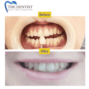Before-and-after comparison showing a significantly whiter smile following professional teeth whitening.