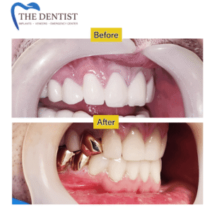 Before-and-after images featuring a newly placed gold dental crown, highlighting a durable and distinctive restoration.