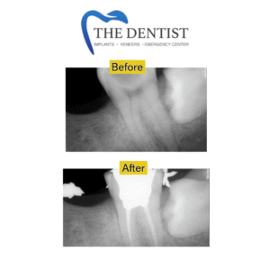 X-ray comparison of a tooth before and after root canal treatment, showing a successful procedure
