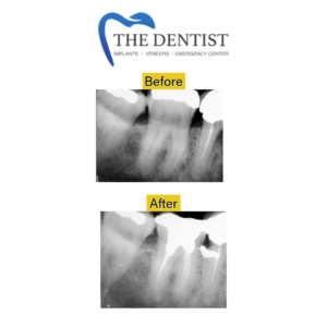 Before-and-after X-rays of a root canal procedure, showing successful treatment and improved tooth health.