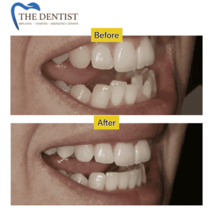 Dental Implants & Smile Makeovers in West Midlands – Transform Your Smile with Expert Cosmetic Dentistry at The Dentist.