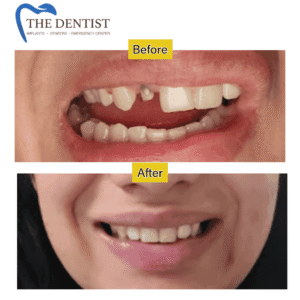 Before and after dental restoration – missing teeth replacement